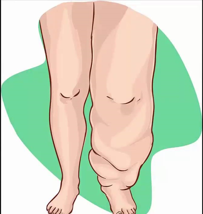 مريضة تعاني من تورم ليمفاوي بالساق.