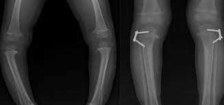 تقوص الركب يمنع هاجر من العودة للمدرسة