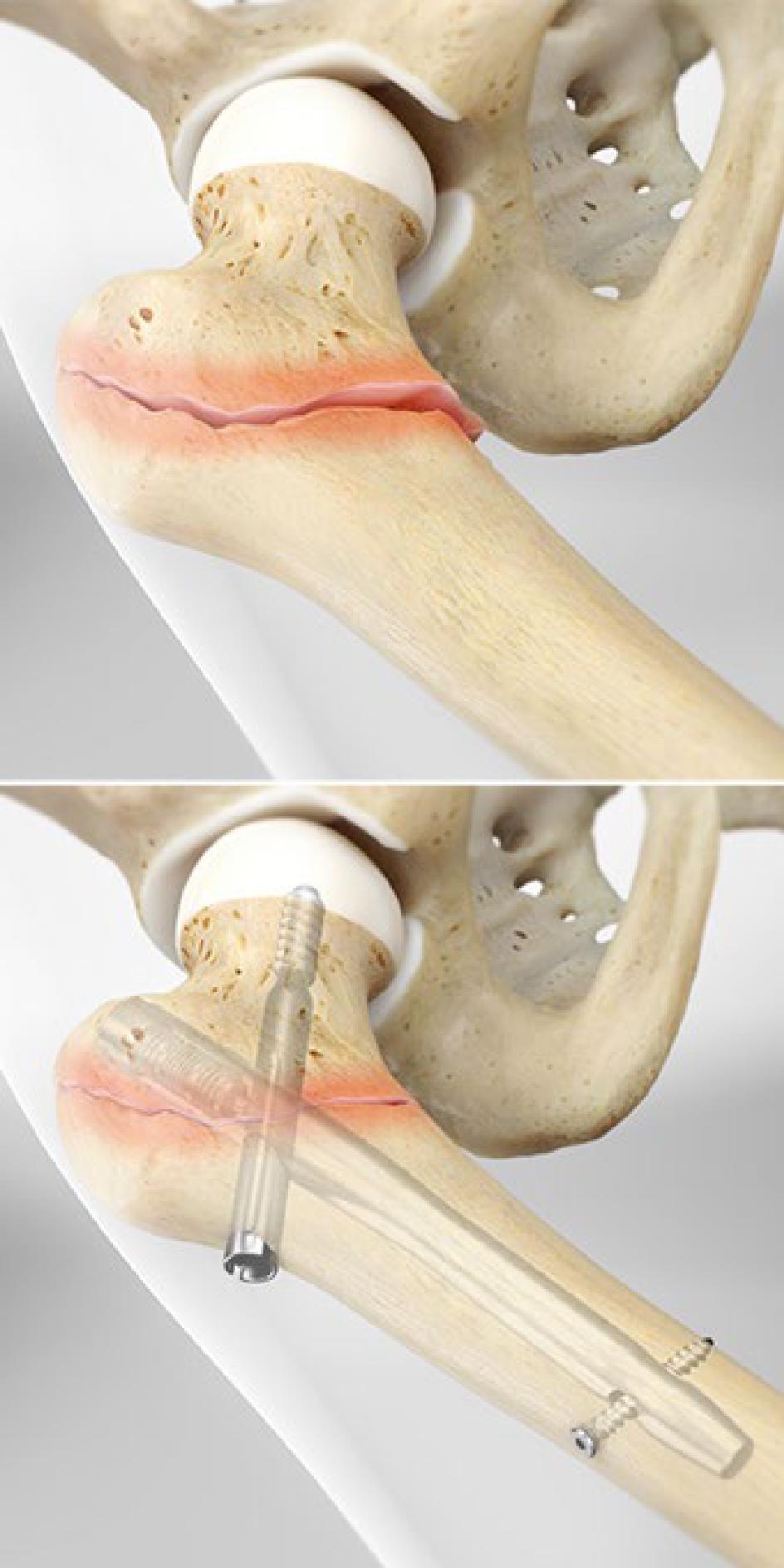 كسر عنق الفخذ أودى بالخالة فلك طريحة الفراش