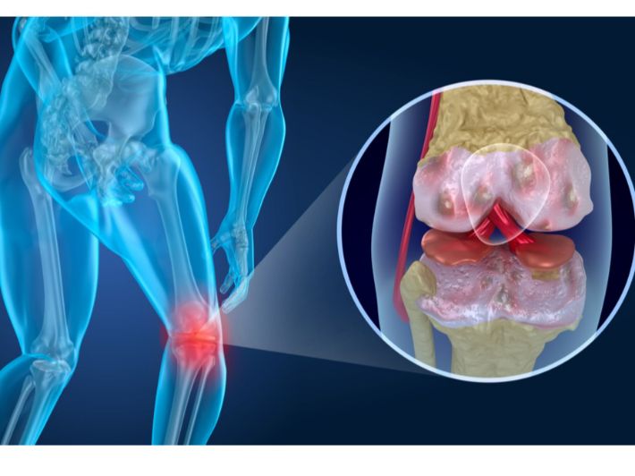  سيدرا تعاني من قطع في الغضروف الهلالي الداخلي للركبة، ونزيف أسفل القدم