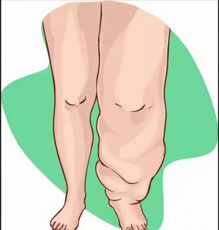 مريضة تعاني من تورم ليمفاوي بالساق.