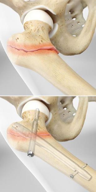 كسر عنق الفخذ أودى بالخالة فلك طريحة الفراش