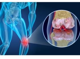  سيدرا تعاني من قطع في الغضروف الهلالي الداخلي للركبة، ونزيف أسفل القدم